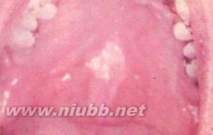 口腔白斑?。嚎谇话装卟?概述，口腔白斑病-診斷_口腔白斑