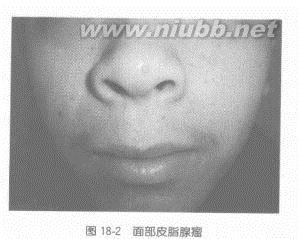 結(jié)節(jié)性硬化癥：結(jié)節(jié)性硬化癥-病因，結(jié)節(jié)性硬化癥-臨床表現(xiàn)_結(jié)節(jié)性硬化癥